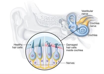 Normal vs Damaged Inner Ear Hair Cells